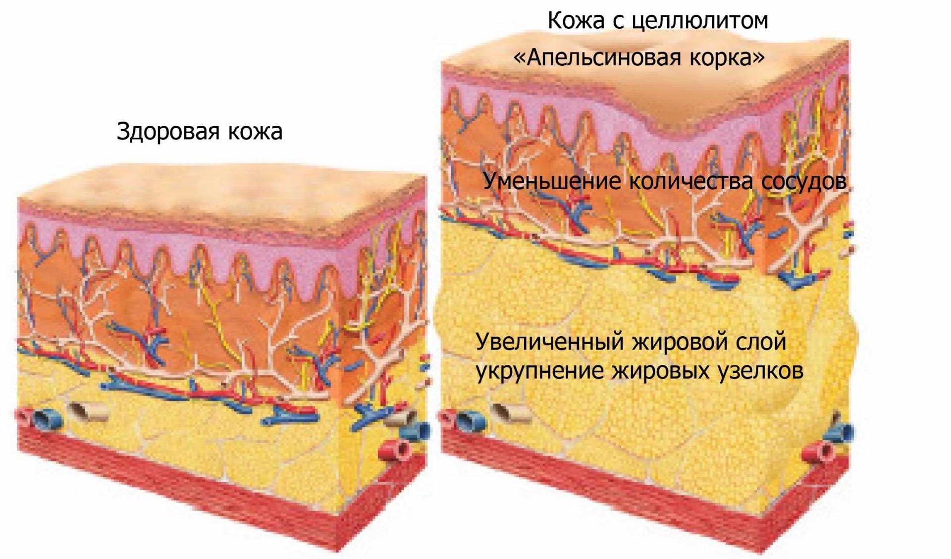 Разрастание тканей кожи Разрастание тканей кожи