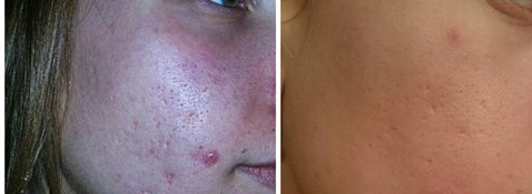 до и после 3 процедур лазерной шлифовки лица