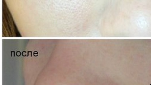 кожные поры: фото до и после