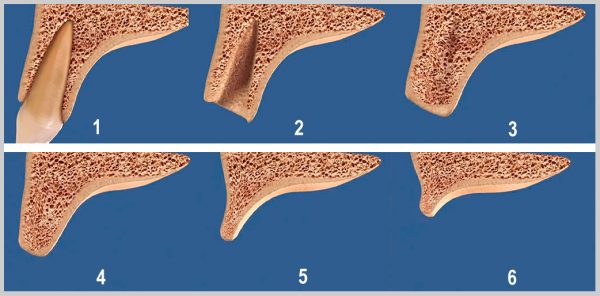 Атрофия костной ткани после удаления зуба