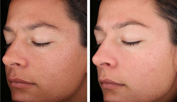 Лицо женщины до и после процедуры лазерной шлифовки