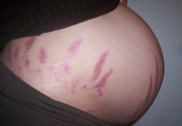 стрии на коже живота у беременной женщины