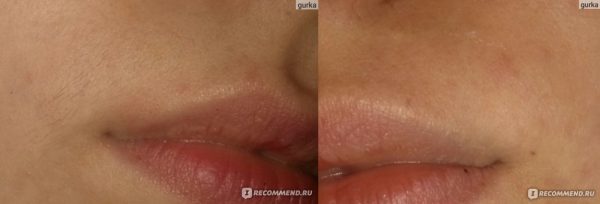 Фото верхней губы до и после использования воска