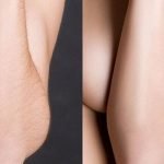 Фотоэпиляция рук: до и после