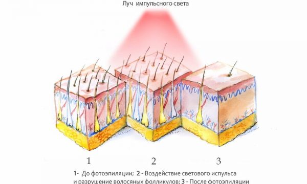 Схема дейтвия рассеянного импульсного света на кожу