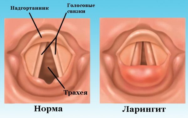 сравнение здоровых голосовых связок и при развитии ларингита