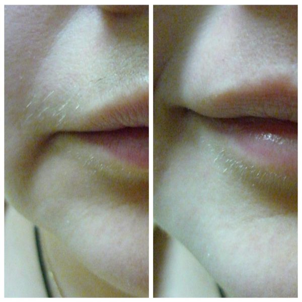 Фото до и после использования восковых полосок в области верхней губы