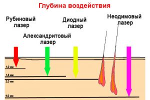 Температура лазера при эпиляции