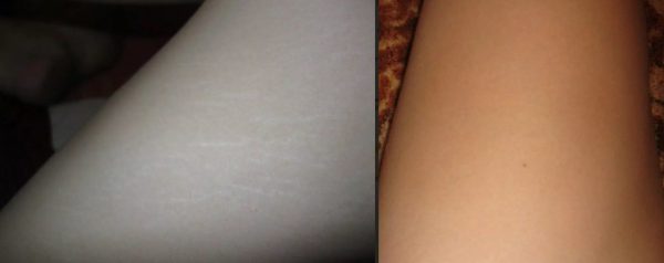 Удаление растяжек лазером на ногах фото до и после