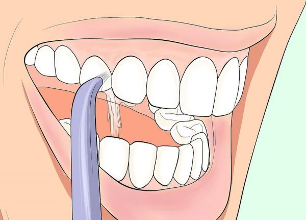 Процедура очистки зубов