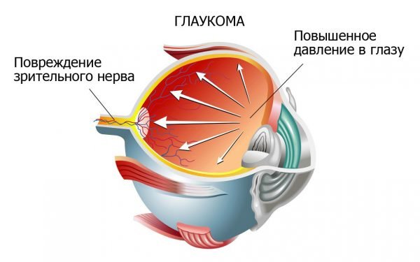 Механизм развития глаукомы