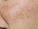 Пигментные пятна на лице